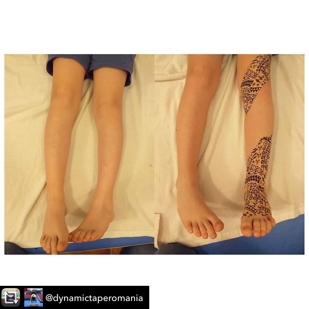 Dynamic Tape 小児の足部・下肢トーンへの応用例
